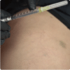 Curso PEIM Microvasos Online