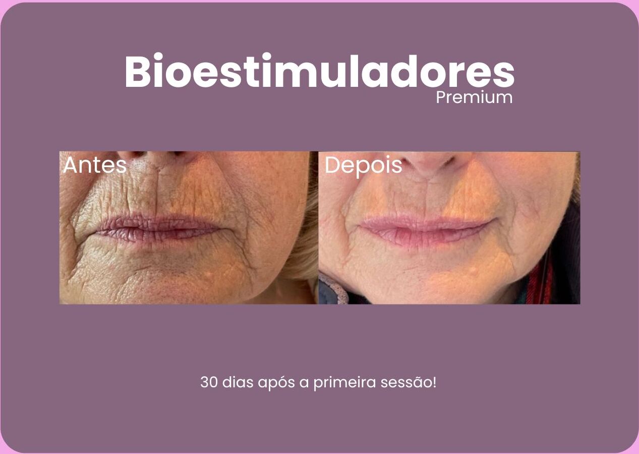 Antes-e-Depois-Bioestimuladores-4-e1710792053135.jpg