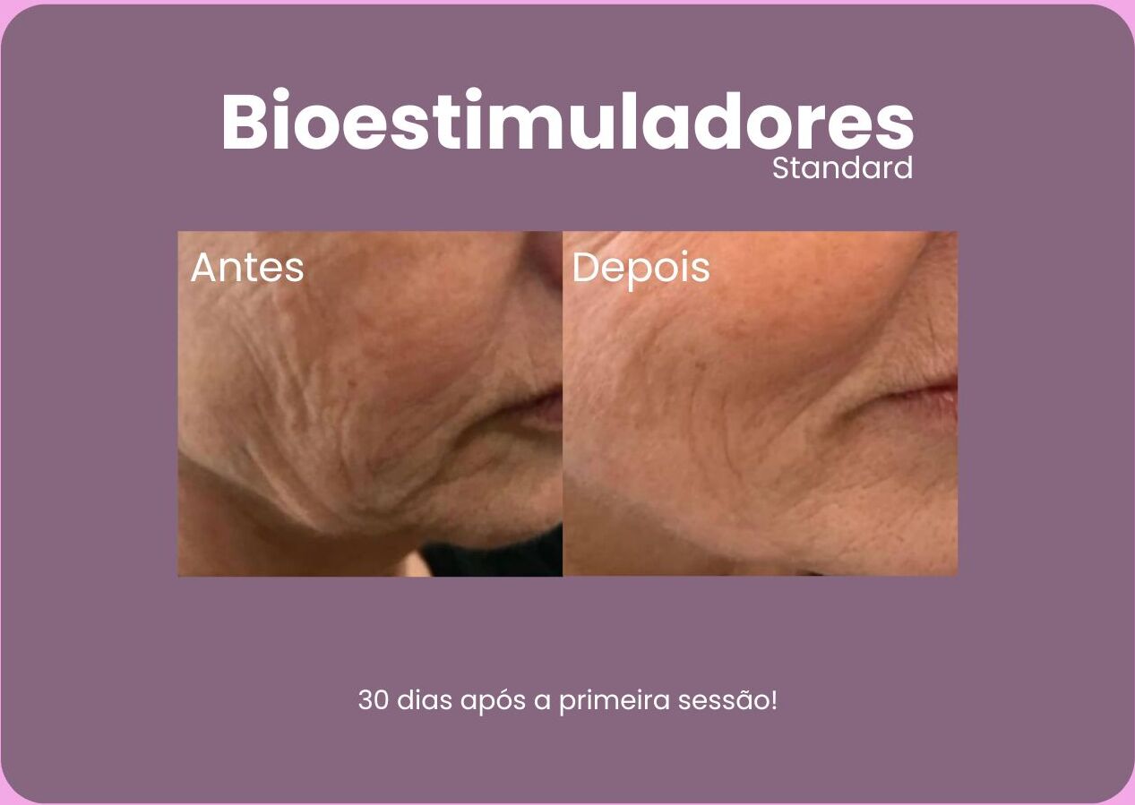 Antes-e-Depois-Bioestimuladores-5-e1710792033640.jpg