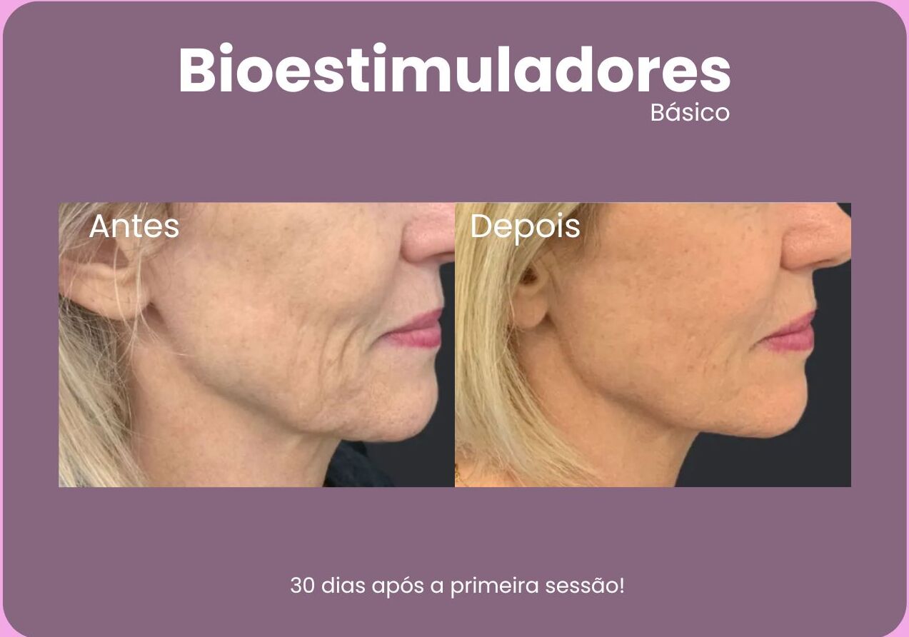 Antes-e-Depois-Bioestimuladores-6-e1710792013626.jpg