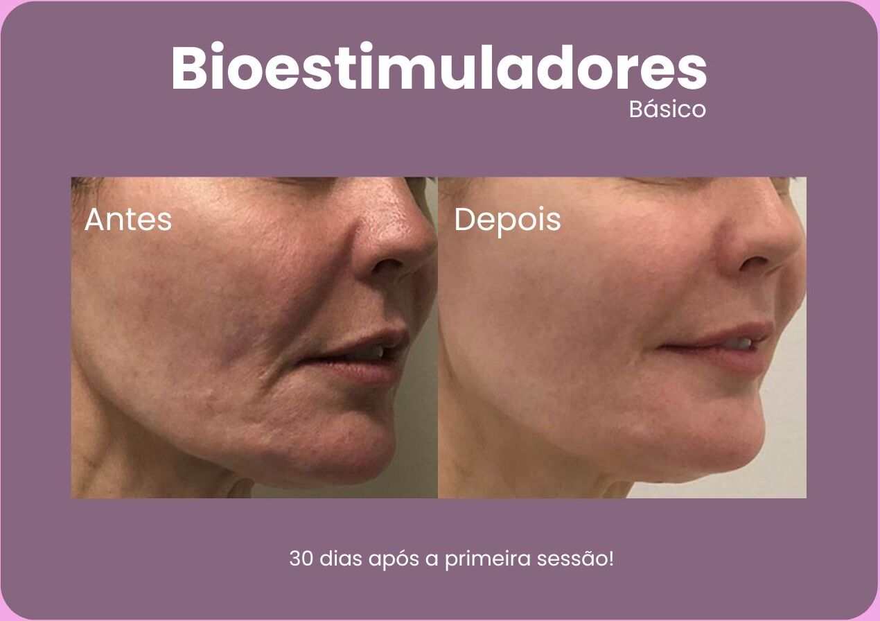 Antes-e-Depois-Bioestimuladores-e1710791444326.jpg