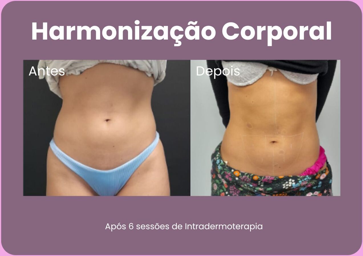 Antes-e-Depois-Harmonizacao-Corporal-1-e1710791226788.jpg