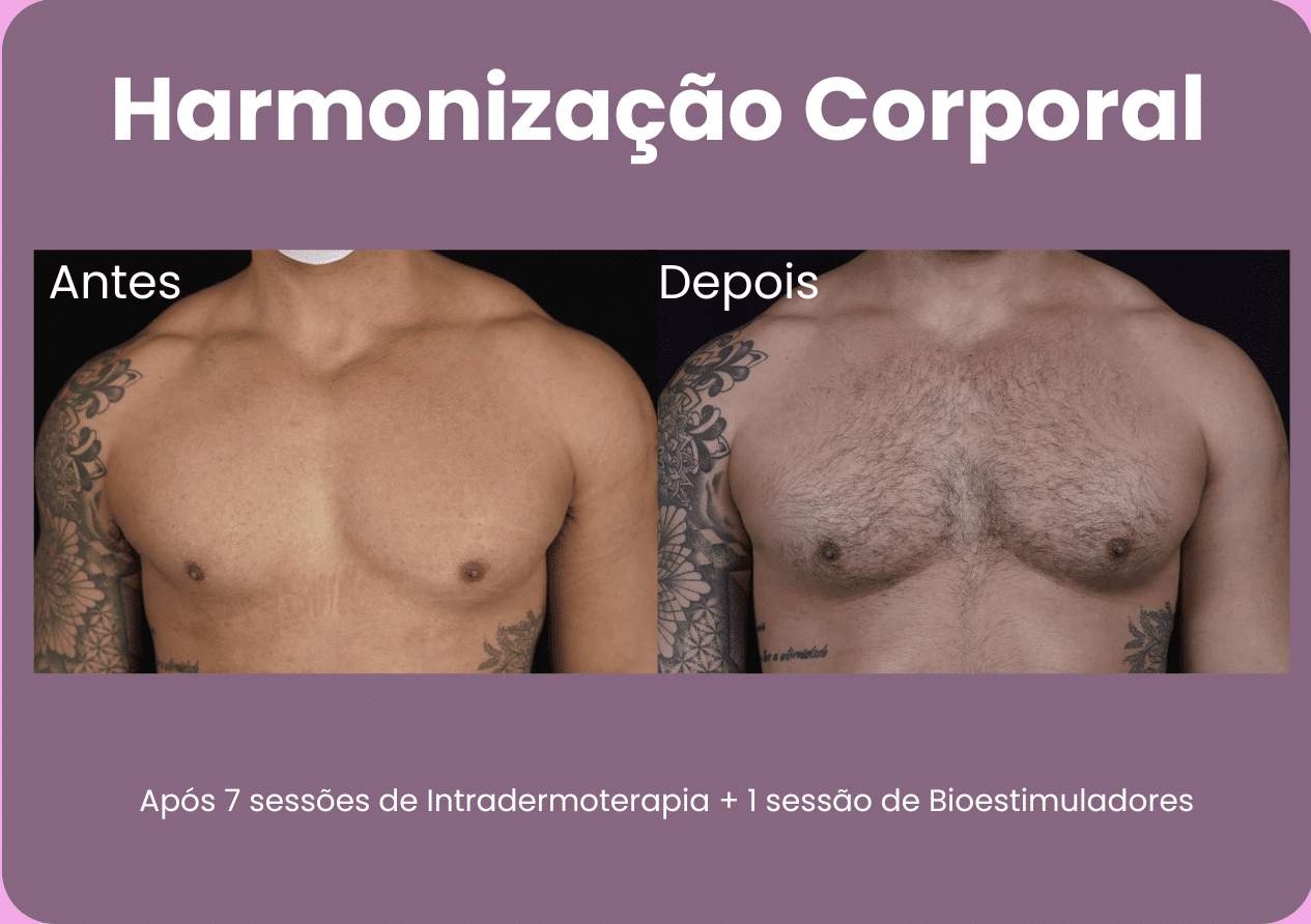 Antes-e-Depois-Harmonizacao-Corporal-2-e1710511286148.png