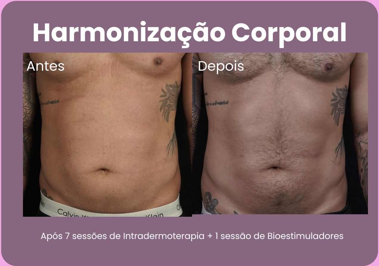 Antes-e-Depois-Harmonizacao-Corporal-e1710791249243.jpg