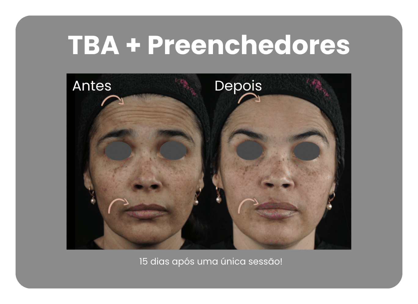 Antes-e-Depois-Harmonizacao-Facial-4.png