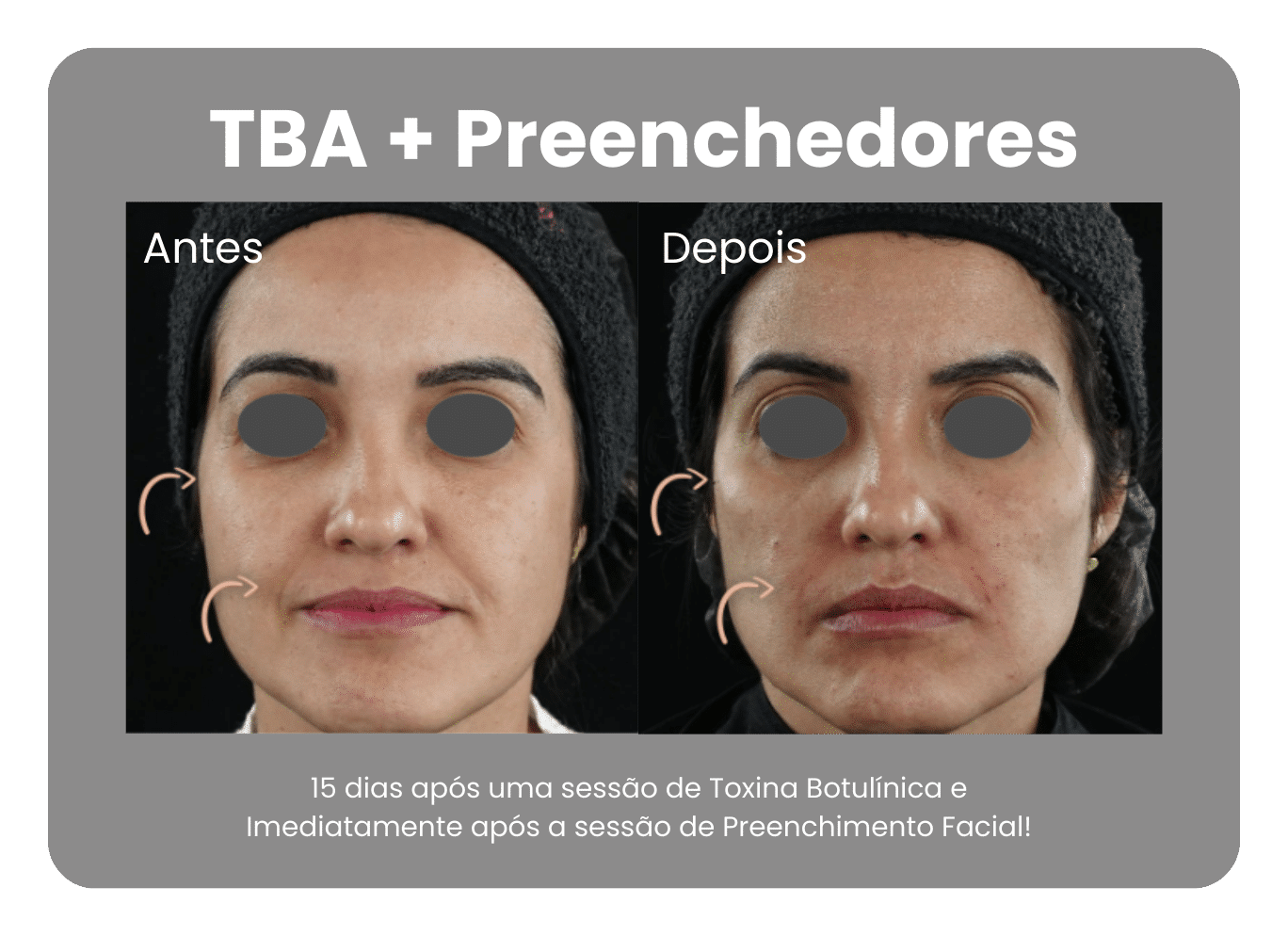 Antes-e-Depois-Harmonizacao-Facial-5.png