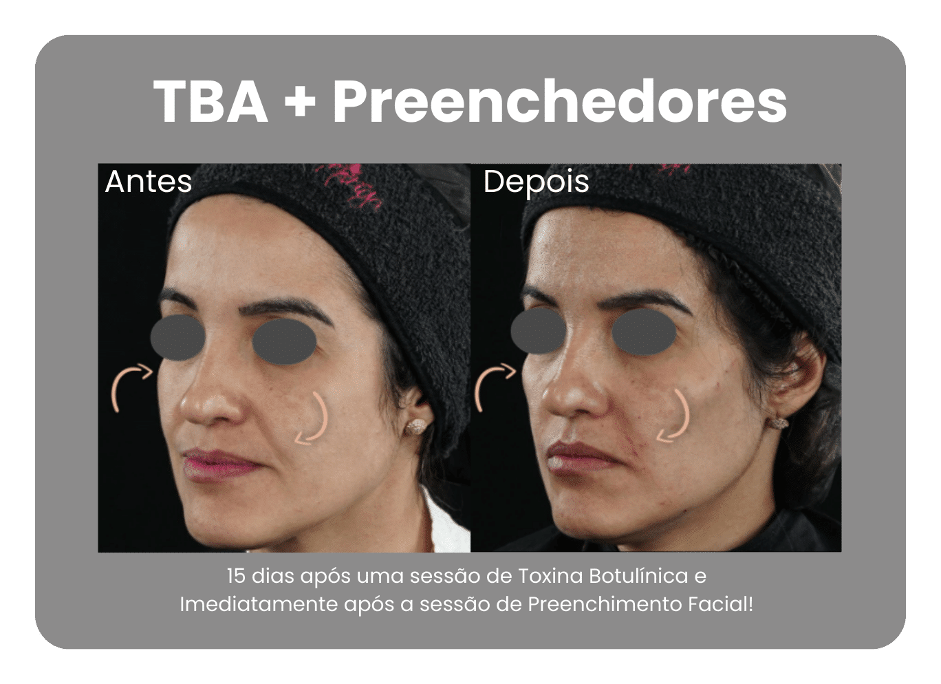 Antes-e-Depois-Harmonizacao-Facial-6.png