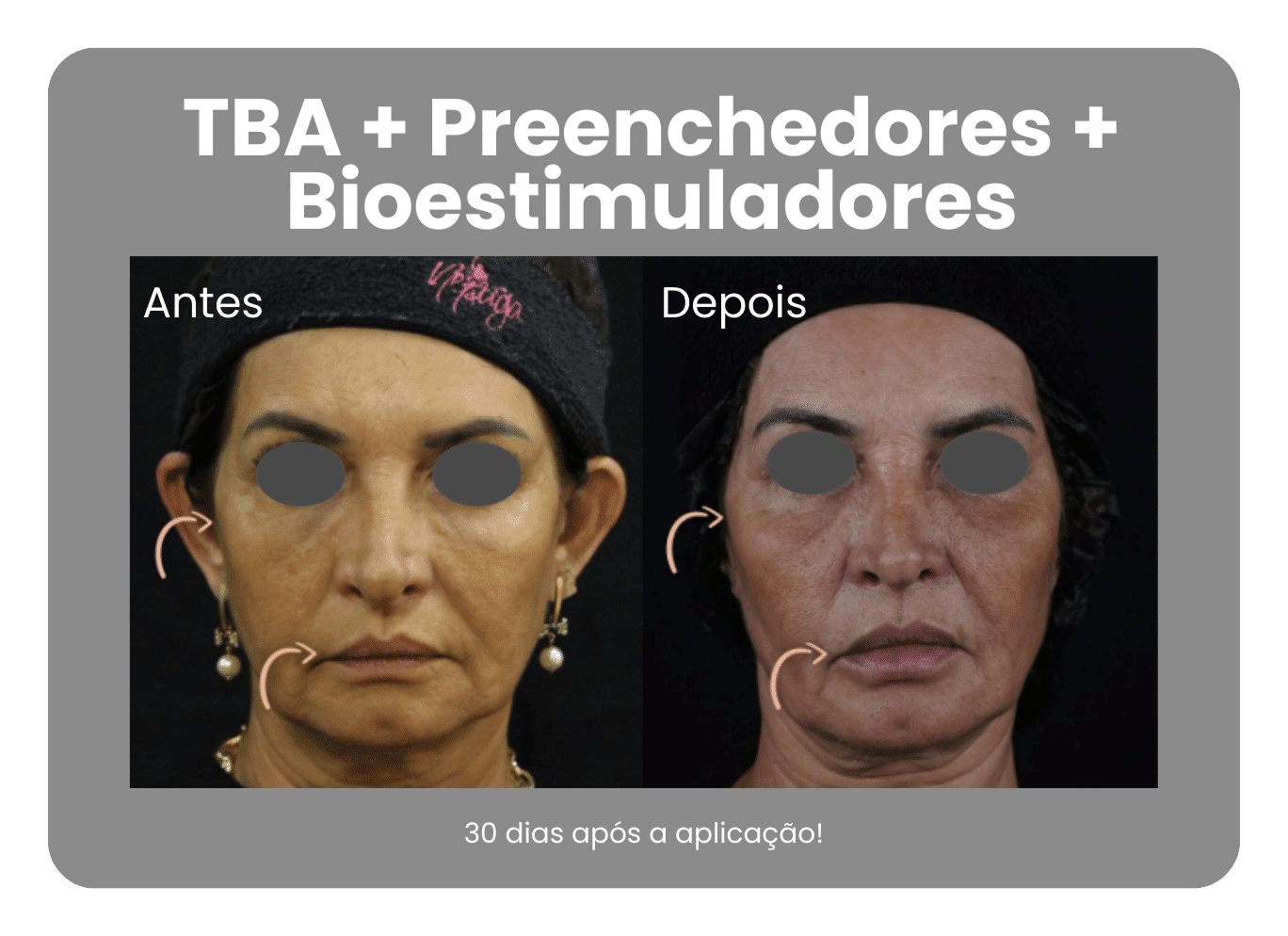 Antes-e-Depois-Harmonizacao-Facial-7.png