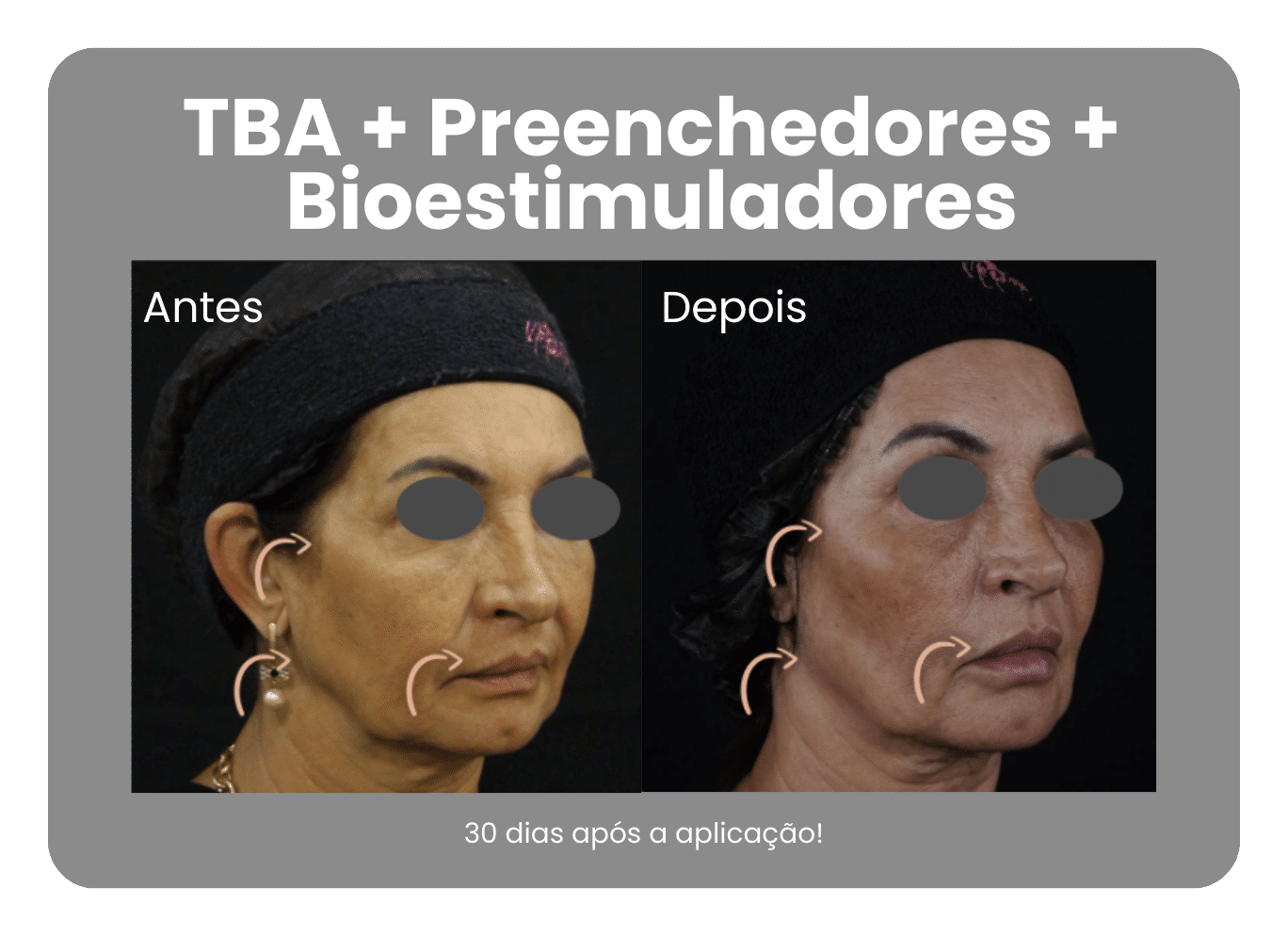 Antes-e-Depois-Harmonizacao-Facial-8.png