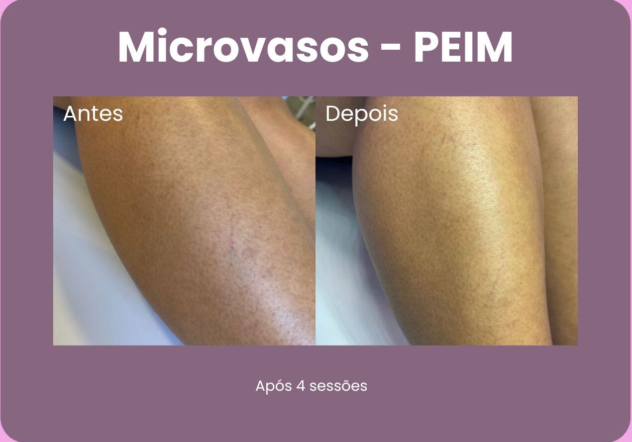 Antes-e-Depois-Microvasos-1-e1710957254524.jpg