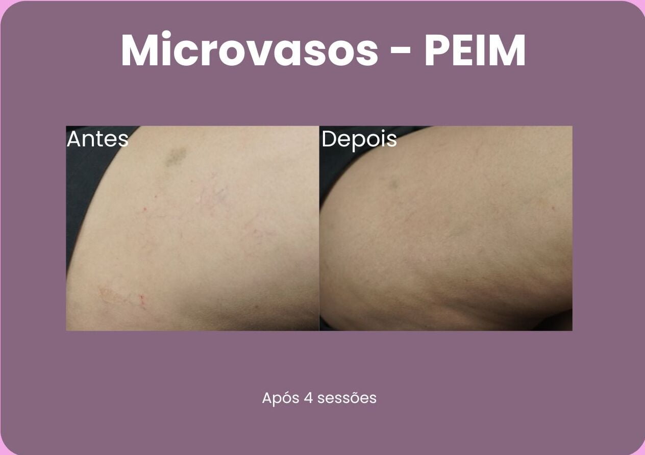 Antes-e-Depois-Microvasos-e1710957276383.jpg