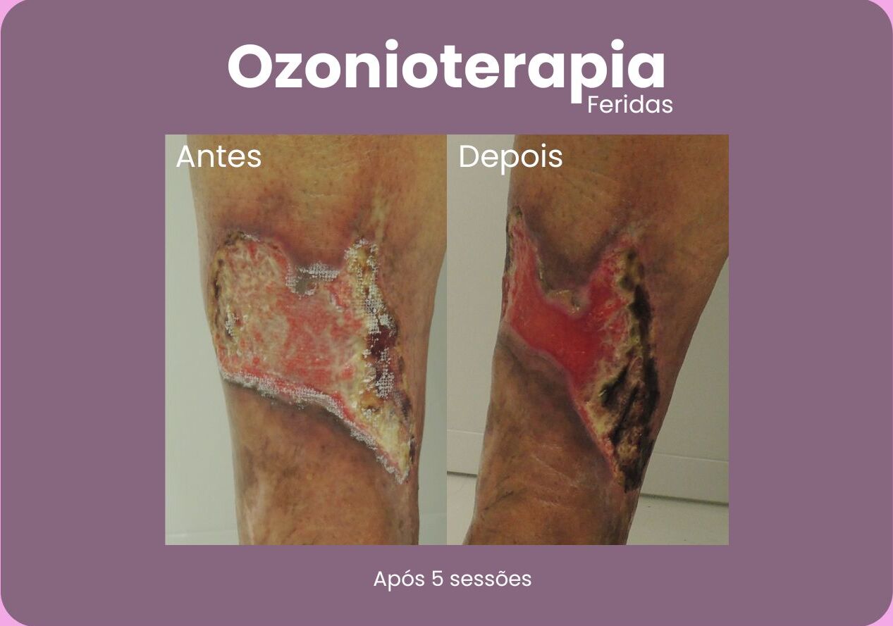 Antes-e-Depois-Ozonioterapia-1-e1710792891291.jpg