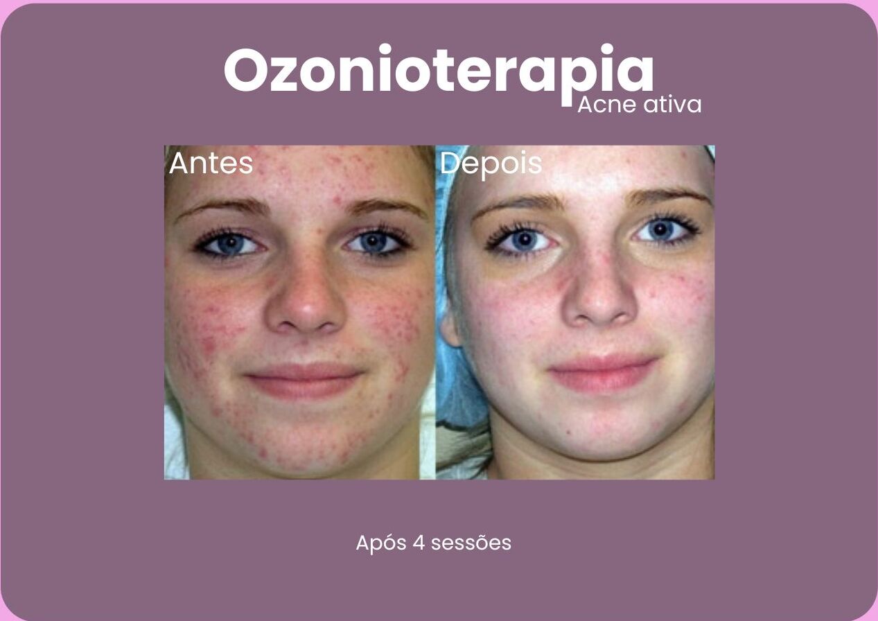 Antes-e-Depois-Ozonioterapia-2-e1710792911157.jpg