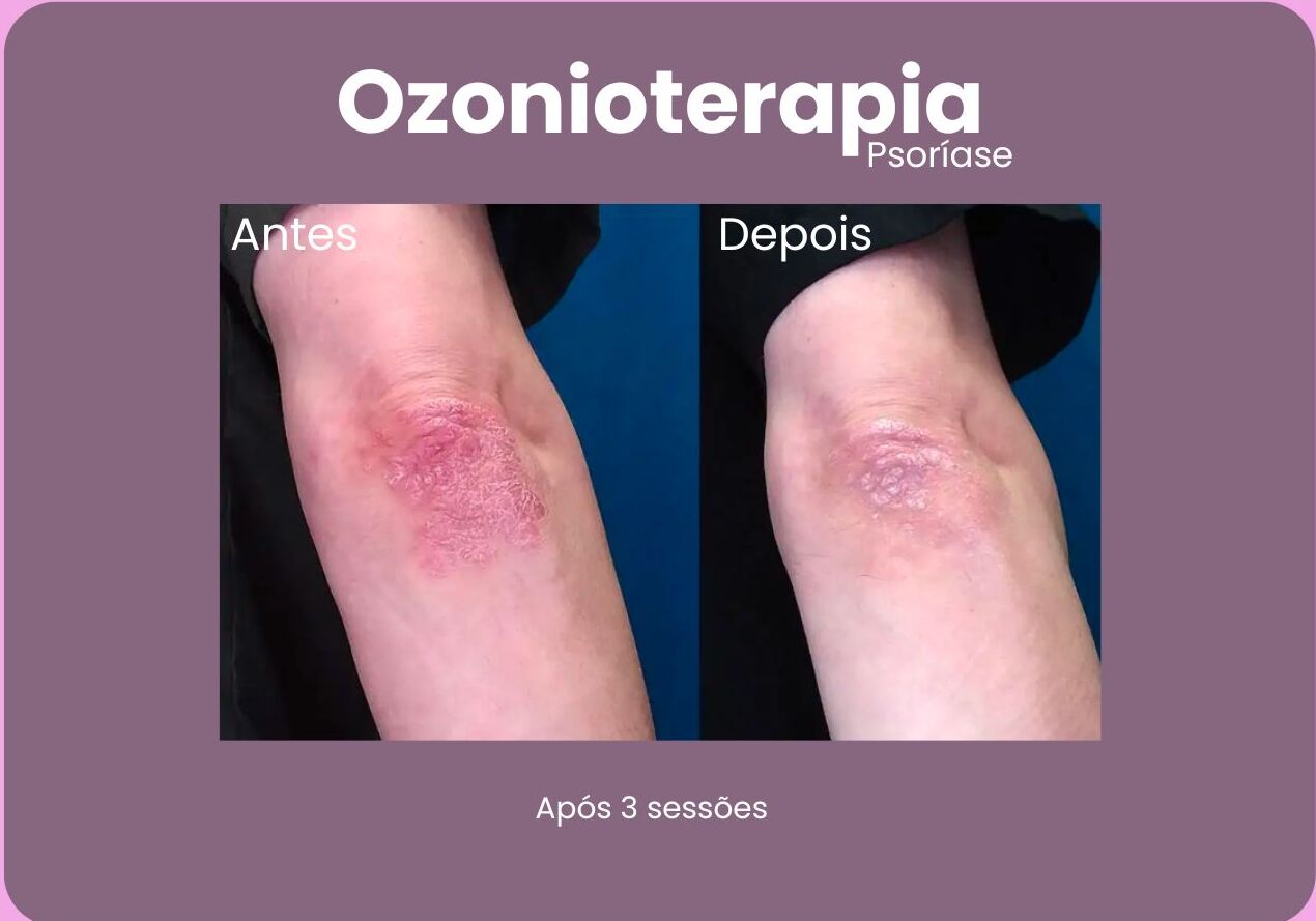 Antes-e-Depois-Ozonioterapia-e1710792867295.jpg