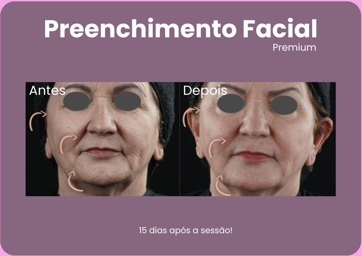 Antes-e-Depois-Preenchimento-Facial-1-e1710961437328.jpg