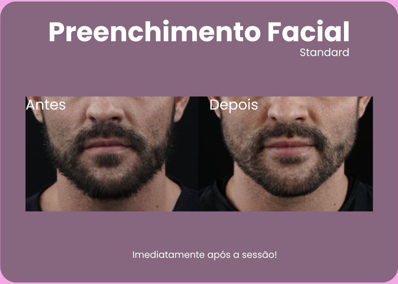 Antes-e-Depois-Preenchimento-Facial-e1710961456848.jpg