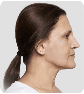 6 fios de sustentação