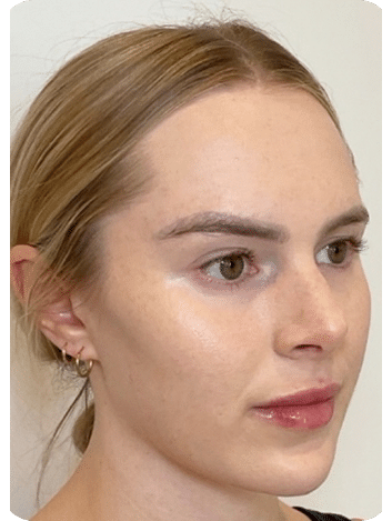 6 harmonização facial