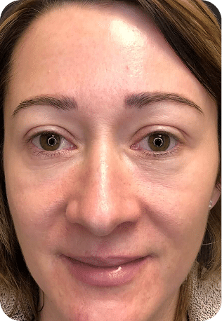 Eletrocautério | Remoção de Lesões Cutâneas - São Paulo 27 6ELETRO