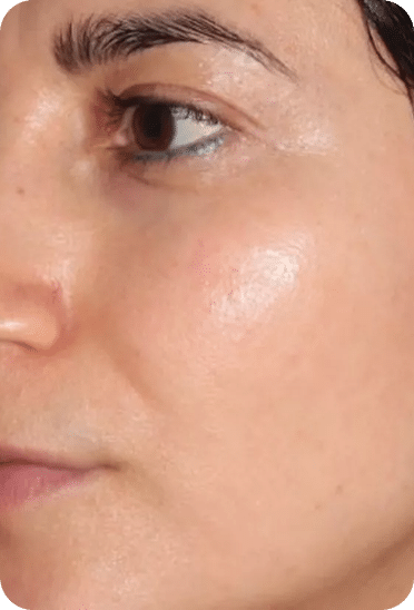 Lavieen | Laser de BB Glow Coreano - Florianópolis 25 6LAVIEENN