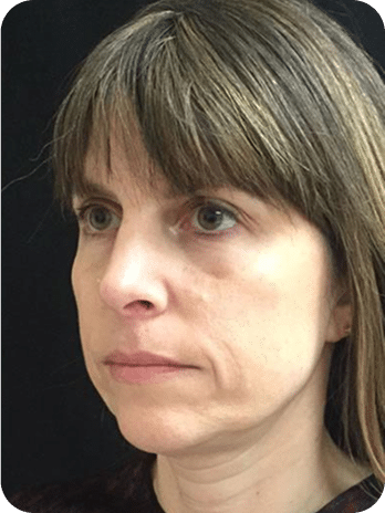 Peelings Químicos & Físicos - Rio de Janeiro 23 6PEELINGS