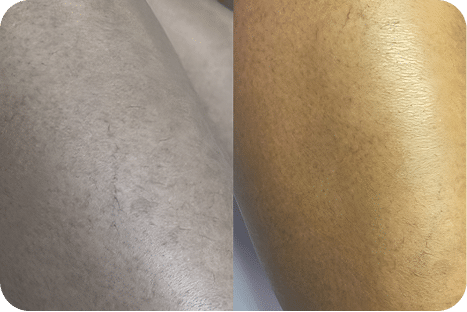 PEIM | Tratamento de Microvasos - Salvador 20 6PEIM