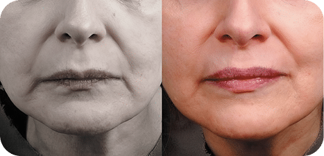 Radiofrequência Corporal e Facial - São Paulo 23 6RADIOF