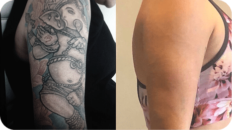 Remoção de Tatuagem com Laser - Goiânia 25 6TATTOO