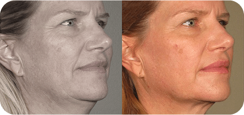 Ultrassom Estético e Microfocado - Salvador 22 6UKLTRASSOM