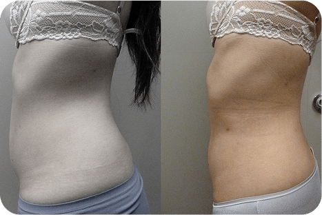 6hidrolipo