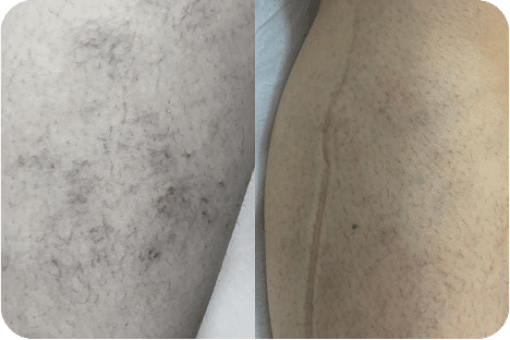 PEIM | Tratamento de Microvasos - Salvador 18 7PEIM