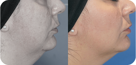 Radiofrequência Corporal e Facial - São Paulo 22 7RADIOF