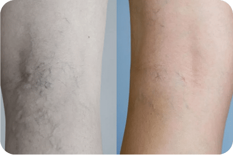 PEIM | Tratamento de Microvasos - Salvador 19 8PEIM