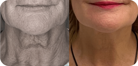 Radiofrequência Corporal e Facial - São Paulo 21 8RADIOF