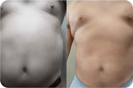 8hidrolipo