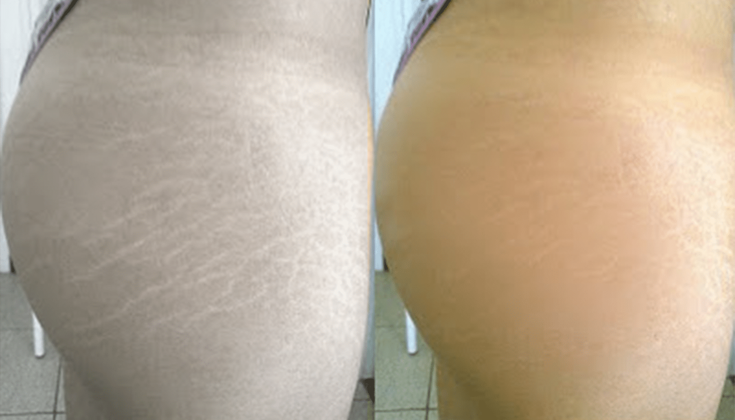 Carboxiterapia-Antes e Depois-1