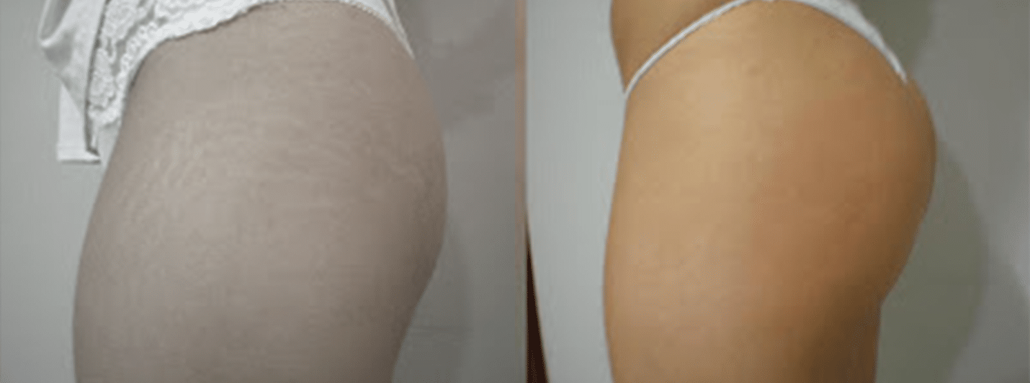 Carboxiterapia-Antes e Depois