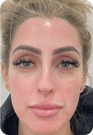 Eletrocautério | Remoção de Lesões Cutâneas - São Paulo 28 DSC03965-scaled-1ELETRO