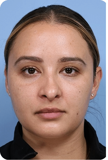 Lavieen | Laser de BB Glow Coreano - Florianópolis 26 DSC03965-scaled-1LAVIEENN