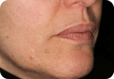 Microagulhamento | Derma Pen & Roller 21 DSC03965-scaled-1MICROAGULHAMENTO