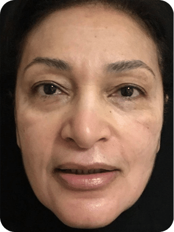 Peelings Químicos & Físicos - Rio de Janeiro 24 DSC03965-scaled-1PEELINGS