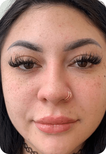 PRP & PRF | Plasma Rico em Plaquetas ou Fibrina - Goiânia 28 DSC03965-scaled-1PRP