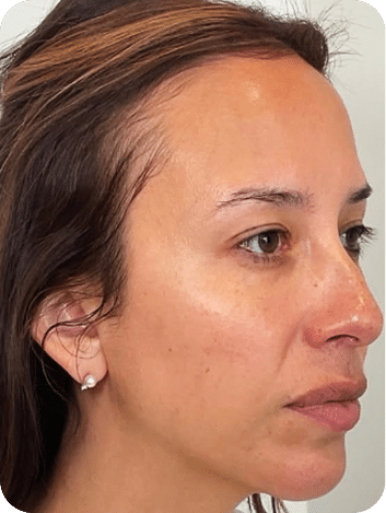 DSC04262-scaled-1 harmonização facial