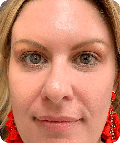 Eletrocautério | Remoção de Lesões Cutâneas - São Paulo 25 DSC04262-scaled-1ELETRO