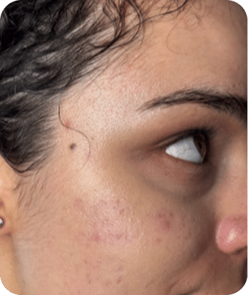 LED Terapia | Fototerapia Facial - Rio de Janeiro 25 DSC04262-scaled-1LED