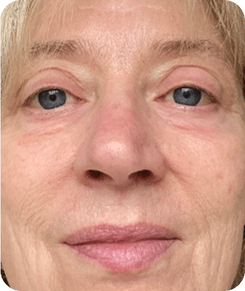 LED Terapia | Fototerapia Facial - Rio de Janeiro 26 DSC04262-scaled-1LED -1