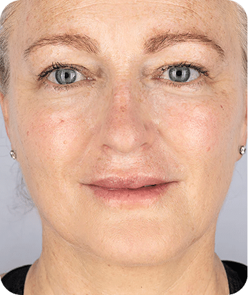 LED Terapia | Fototerapia Facial - Rio de Janeiro 23 DSC04262-scaled-1LED -2