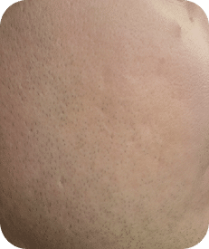 Microagulhamento | Derma Pen & Roller 19 DSC04262-scaled-1MICROAGULHAMENTO