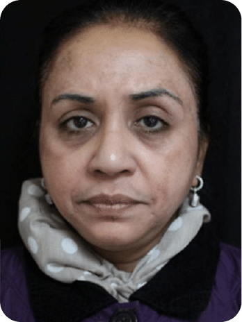 Peelings Químicos & Físicos - Rio de Janeiro 21 DSC04262-scaled-1PEELINGS