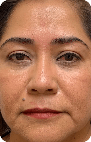 PRP & PRF | Plasma Rico em Plaquetas ou Fibrina - Goiânia 25 DSC04262-scaled-1PRP